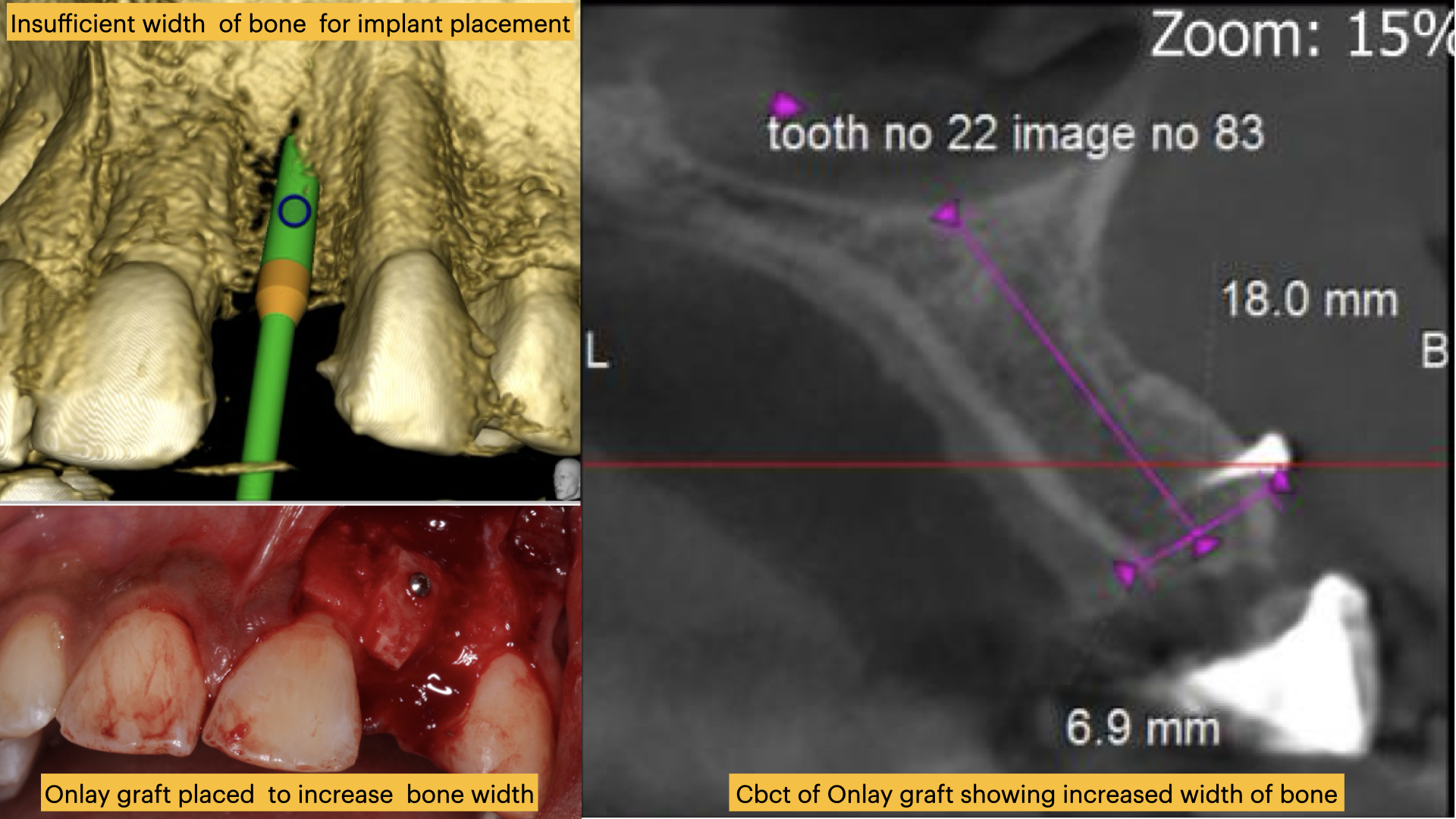 Post-onlay Graft